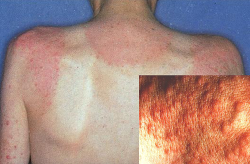 Phát ban đa dạng do ánh sáng - Hình ảnh minh họa